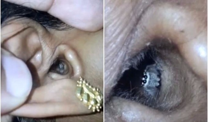 У женщины из Индии в ухе застрял паук. Но он выбрался и рад вас видеть (5 фото + 1 видео)