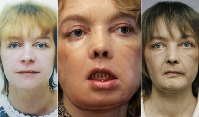 Пересадка лица: чудо руками хирургов (11 фото)
