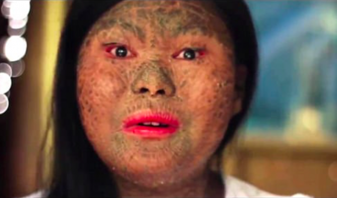 Из-за редкого заболевания кожа этой филиппинки стала похожа на змеиную чешую (4 фото + 1 видео)