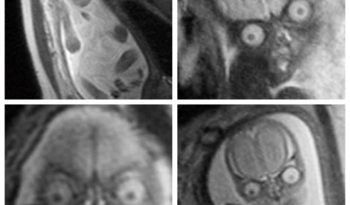 "Поздравляем, у вас демон": жуткий МРТ-снимок беременной женщины (3 фото)