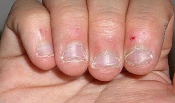 40-летний мужчина умер от того, что грыз ногти (3 фото)