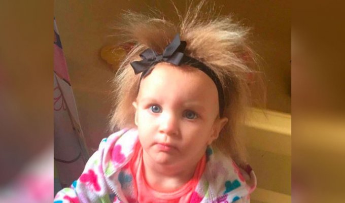 Малышке нельзя расчёсывать волосы из-за редкого заболевания, но ей это нравится (10 фото)