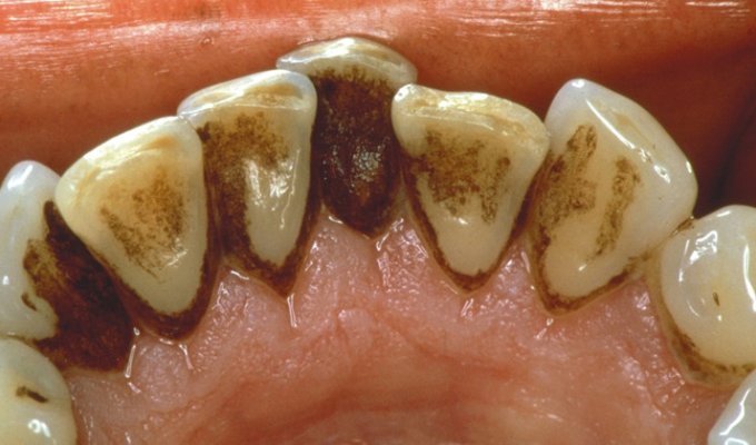 Как без помощи стоматолога можно удалить зубной налёт? (1 фото)