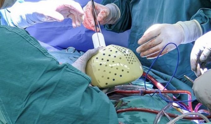 В США впервые в истории имплантировали человеку полностью искусственное сердце (5 фото)