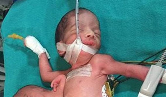 Жуткие кадры! В Индии родился младенец с двумя головами и выжил (5 фото)