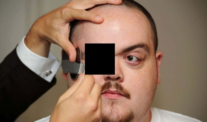 Человек с самыми выпирающими глазами в мире (4 фото) (жесть)