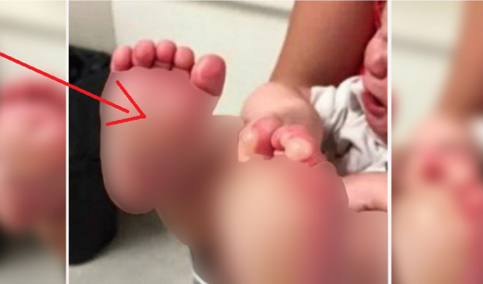 Мать вернулась домой и увидела огромные волдыри на ногах у ребенка (3 фото)