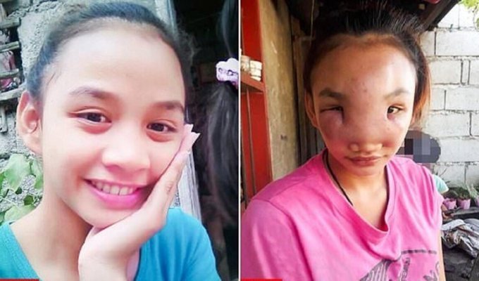 Молодая филиппинка, выдавив прыщ, осталась без лица (6 фото + 1 видео)