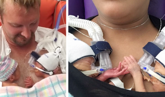 Недоношенные близнецы, держащиеся за руки, покорили интернет (6 фото + 1 видео)