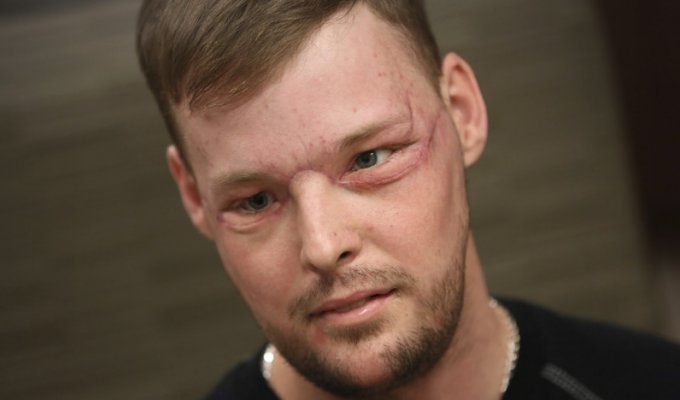 Невероятные результаты пересадки лица, сделанной парню после того, как он выстрелил себе в лицо (13 фото)