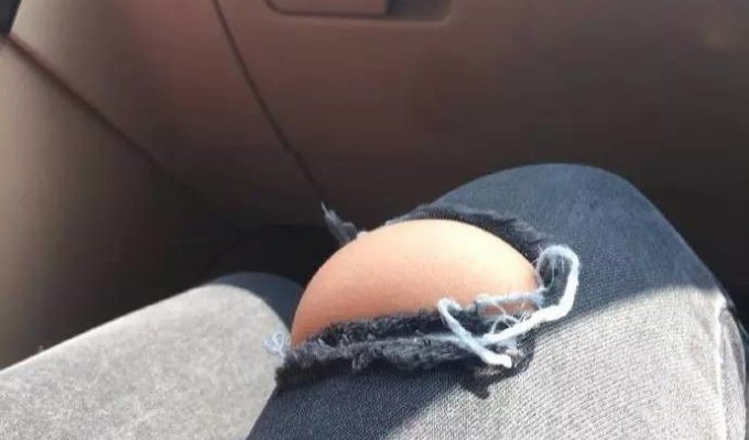 Девушка натянула рваные джинсы на отекшие ноги (4 фото)