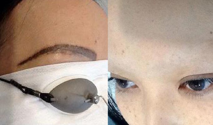 Злоупотребление косметическим татуажем оставило женщину вовсе без бровей (5 фото)