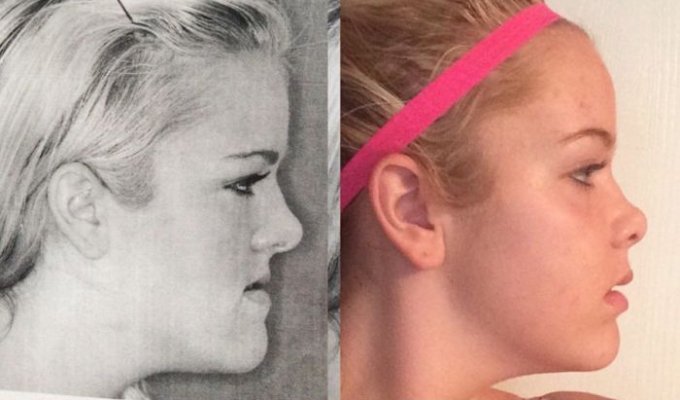 Как хирургия челюсти помогла девушке (2 фото)
