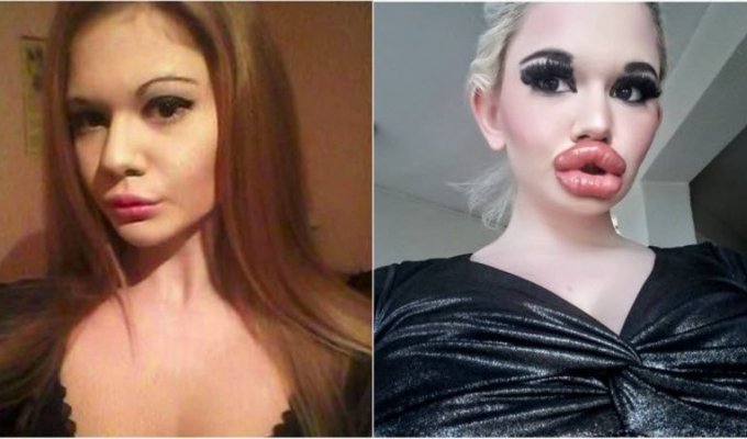 Девушка из Болгарии с самыми большими в мире губами провела 20-ю процедуру по их увеличению (12 фото)