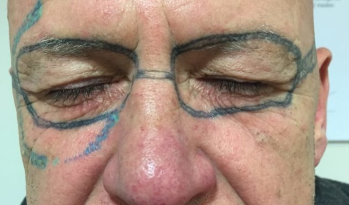 Мужчина решил избавиться от татуировки в виде очков на своём лице (4 фото)