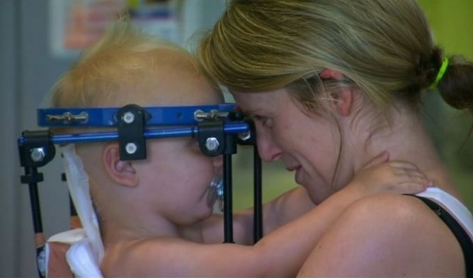 Австралийские врачи спасли жизнь ребенку, которому практически полностью оторвало голову в ДТП (2 фото)