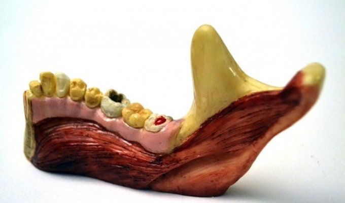 Аппетитные челюсти со следами серьезного заболевания десен (3 фото)