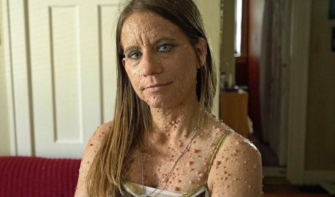 «Все, что я хочу — быть обожаемой»: Женщина пытается избавиться от 6 тысяч опухолей (10 фото)