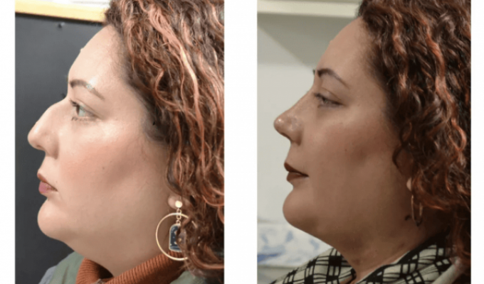 "До и после": люди, которые решились на пластическую операцию и не пожалели (18 фото)