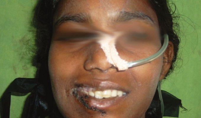 Операция по удалению лишнего рта у индийской девочки (11 фото)