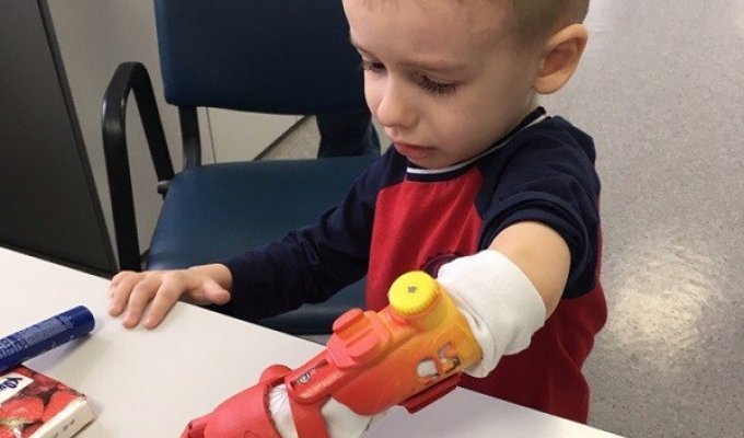 Впервые в России ребенку установили 3D-печатный протез (5 фото)