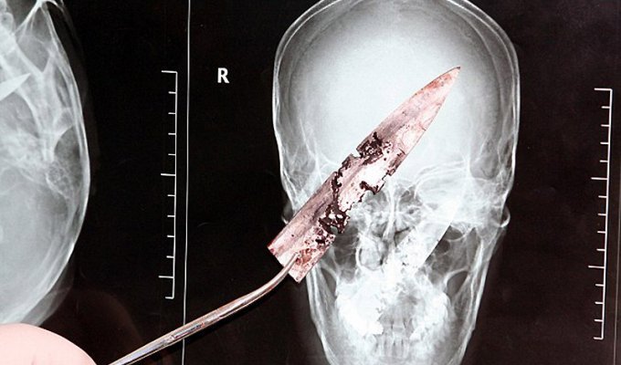 Китаец прожил четыре года с ножом в черепе (5 фото)
