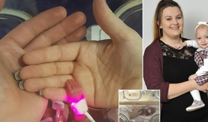 В Великобритании врачи спасли девочку, весившую при рождении 340 граммов (5 фото)