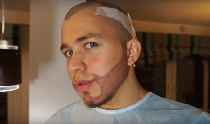 Актер из сериала «Кухня» пересадил себе густую бороду (1 фото + 1 видео)