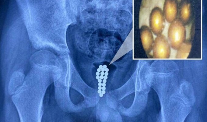 В Китае врачи вытащили из пениса мальчика 20 магнитных шариков (4 фото)