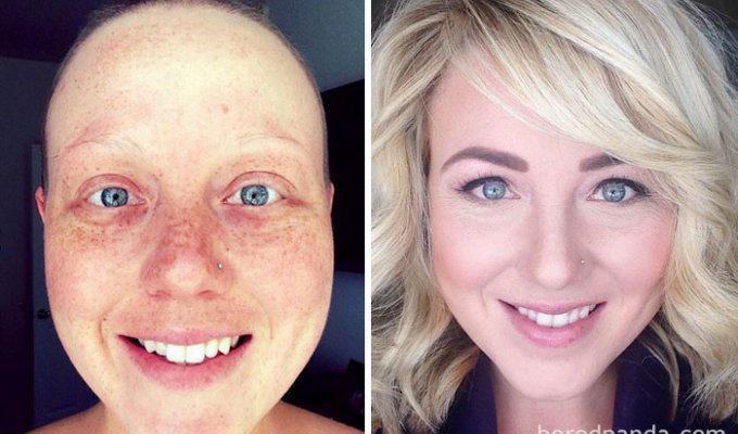 Люди, победившие рак: поразительные фото до и после (47 фото)