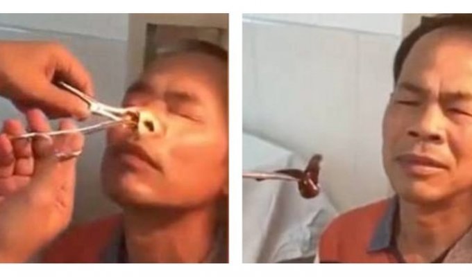 Из носа китайца извлекли огромную пиявку (3 фото + 1 видео)