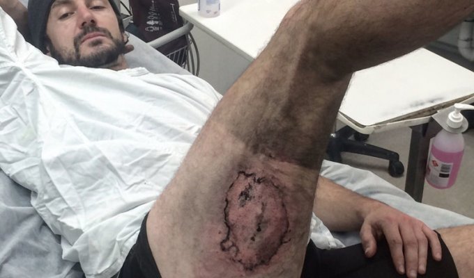 Велосипедист упал на свой iPhone 6 и получил сильный ожог (4 фото)