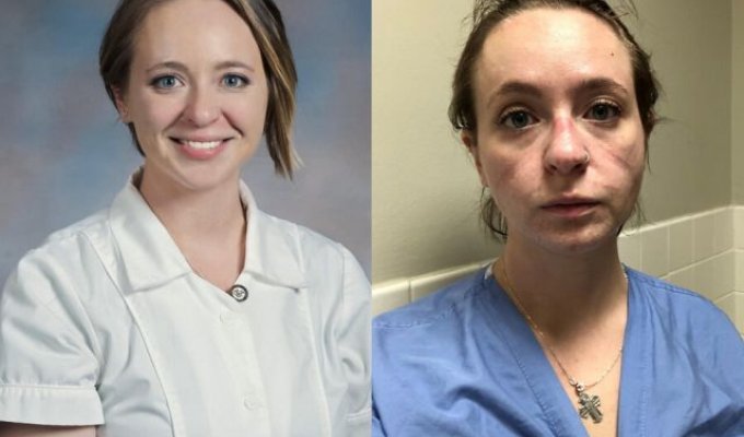 Медсестра Кэтрин Айви показала, как ее лицо изменила работа в больнице за полгода пандемии коронавируса (6 фото)