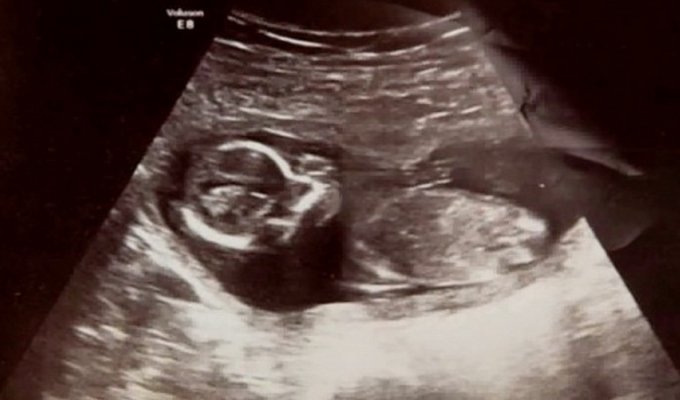 Через неделю после выкидыша в утробе 31-летней матери продолжает биться маленькое сердце (6 фото)
