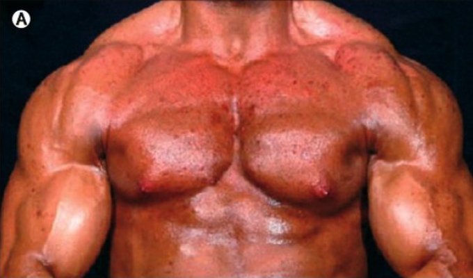 Вот что стеройды делают с телом "спортсмена"(3 фото)(жесть дня)