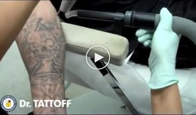 Архив. Как удаляют татуировку