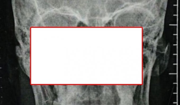 Житель ЮАР четыре дня провел с 10-сантиметровым лезвием ножа в черепе (4 фото)