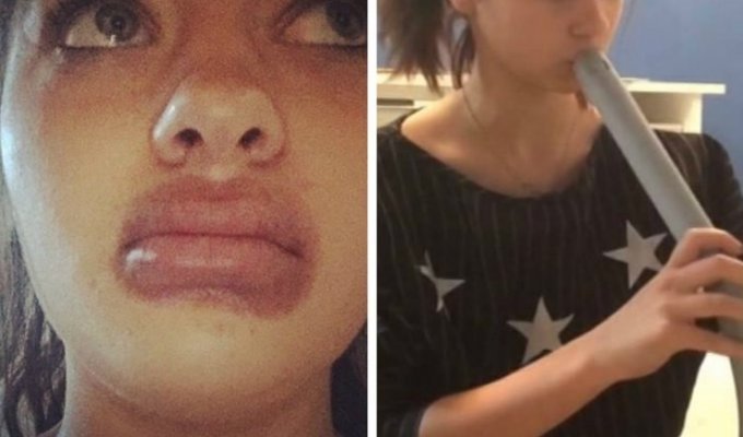 19-летняя ростовчанка попыталась увеличить губы пылесосом (2 фото)