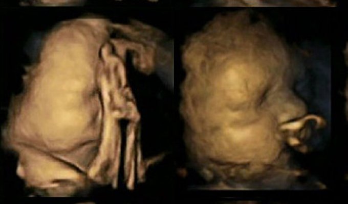 Реакция ребенка в утробе матери на курение (2 фото)