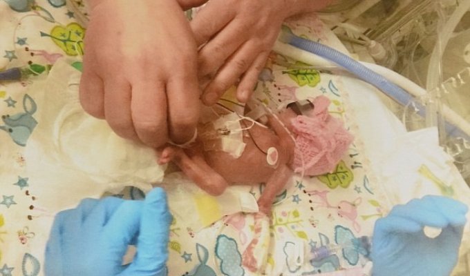 Крошечная девочка выжила, несмотря на неблагоприятные прогнозы медиков (5 фото)