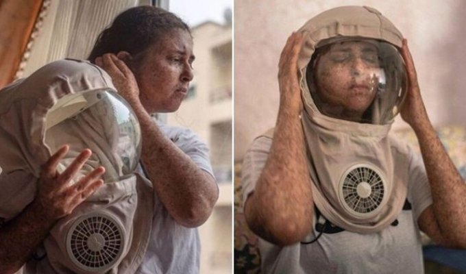 Женщина с аллергией на солнце не выходит на улицу без маски уже двадцать лет (3 фото)