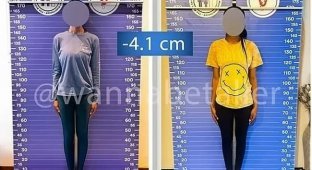Модели больше не в моде? Зачем женщины делают операции по укорачиванию ног (6 фото)