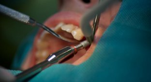 Как делают имплантацию зубов (33 фото)