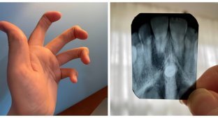 Unusual bodily anomalies shared by their owners themselves (21 photos)