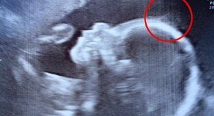 Doctors noticed strange contours in the ultrasound image. Now passers-by look at this girl with surprise! (3 photos)