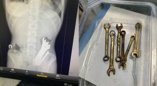 Украинец на спор проглотил шесть гаечных ключей (3 фото)
