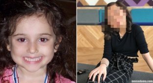 An ordinary girl developed a rare pathology at the age of 6, which distorted half of her face (7 photos)