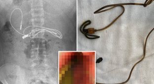 Doctors found in the intestines of a teenager a USB cord and an elastic band for hair (3 photos + 1 video)