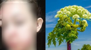 Жертва ботаники: девушка гуляла по полю и захотела съесть ревень, но оказалось, что это борщевик (6 фото)