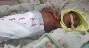 Двухнедельный младенец с редким заболеванием кожи (5 фото)